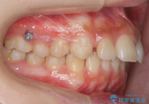 前歯が出っ歯ですきっ歯　抜かずに前歯を見た目良くの治療中