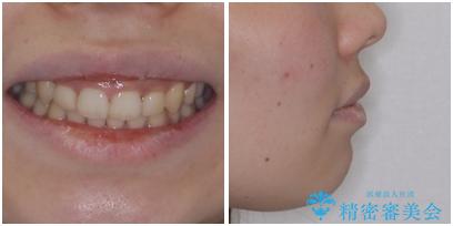 下顎前歯が隠れて突出した口元 ワイヤー装置での抜歯矯正の治療後(顔貌)