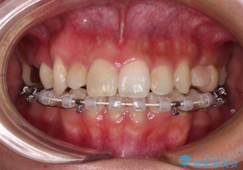気になる八重歯 目立ちにくいハーフリンガルでの抜歯矯正の治療中