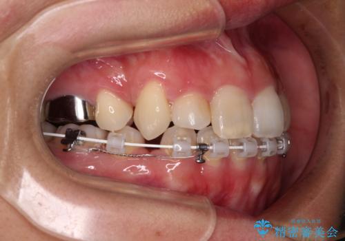 気になる八重歯 目立ちにくいハーフリンガルでの抜歯矯正の治療中