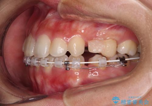 気になる八重歯 目立ちにくいハーフリンガルでの抜歯矯正の治療中