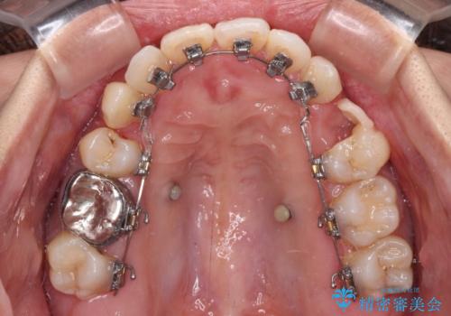 気になる八重歯 目立ちにくいハーフリンガルでの抜歯矯正の治療中