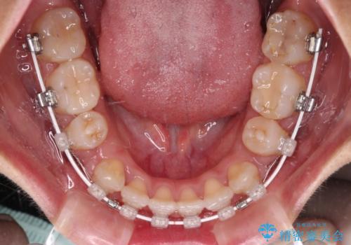 気になる八重歯 目立ちにくいハーフリンガルでの抜歯矯正の治療中