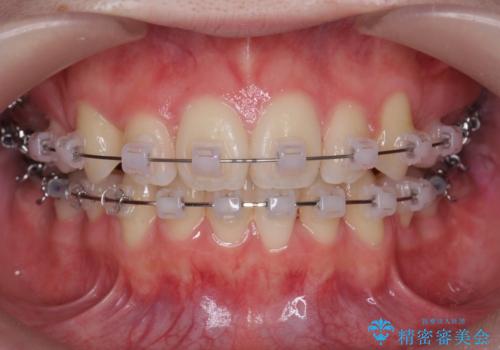 八重歯 歯並びのがたつきの治療中