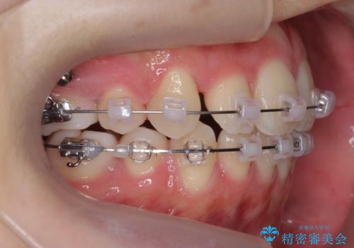 八重歯　歯並びのがたつきの治療中