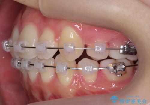八重歯 歯並びのがたつきの治療中