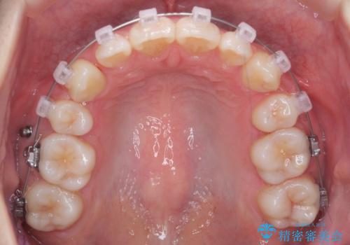 八重歯 歯並びのがたつきの治療中