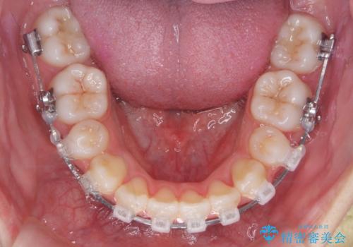 八重歯 歯並びのがたつきの治療中