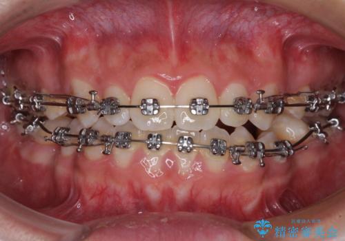 口元の突出感を改善　受け口傾向の咬み合わせの抜歯矯正の治療中
