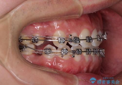 口元の突出感を改善 受け口傾向の咬み合わせの抜歯矯正の治療中