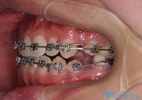 口元の突出感を改善　受け口傾向の咬み合わせの抜歯矯正の治療中
