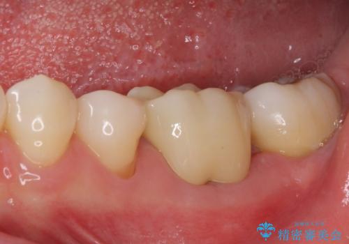 むし歯で歯茎から血が出てくる オールセラミッククラウンでの補綴治療の治療後
