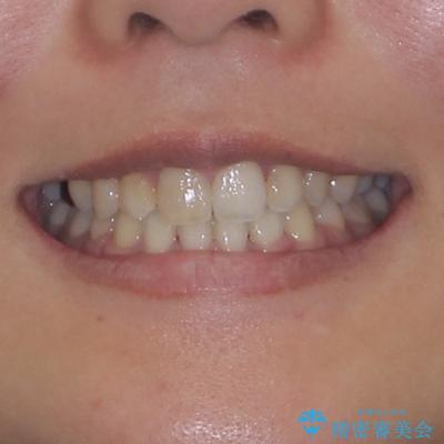気になる八重歯 目立ちにくいハーフリンガルでの抜歯矯正の治療後(顔貌)
