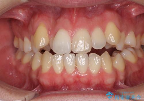 左右の八重歯が気になる　ワイヤー装置での咬み合わせ改善の症例 治療前