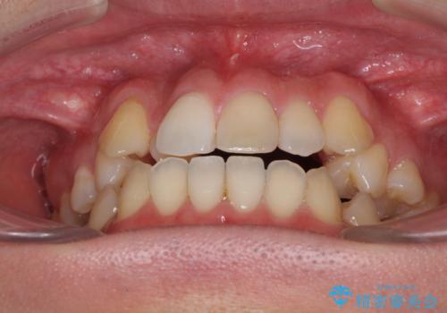 左右の八重歯が気になる ワイヤー装置での咬み合わせ改善の治療前