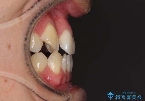 左右の八重歯が気になる ワイヤー装置での咬み合わせ改善の治療前