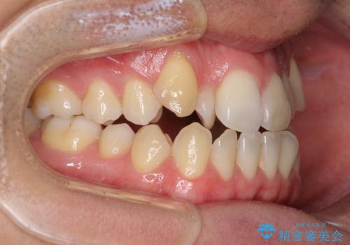 左右の八重歯が気になる ワイヤー装置での咬み合わせ改善の治療前