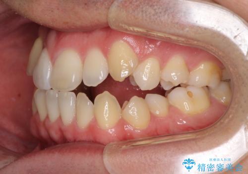 左右の八重歯が気になる ワイヤー装置での咬み合わせ改善の治療前