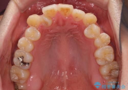 左右の八重歯が気になる ワイヤー装置での咬み合わせ改善の治療前
