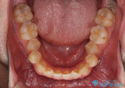 左右の八重歯が気になる ワイヤー装置での咬み合わせ改善の治療前