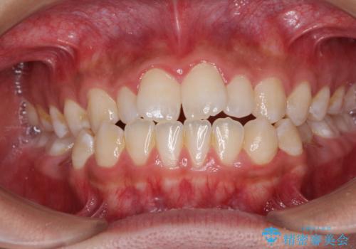 口元の突出感を改善　受け口傾向の咬み合わせの抜歯矯正の症例 治療前