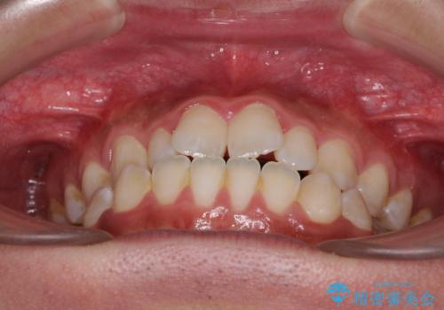 口元の突出感を改善 受け口傾向の咬み合わせの抜歯矯正の治療前