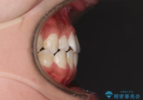 口元の突出感を改善　受け口傾向の咬み合わせの抜歯矯正の治療前
