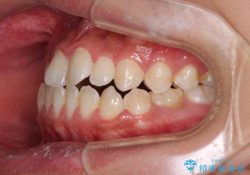 口元の突出感を改善 受け口傾向の咬み合わせの抜歯矯正の治療前