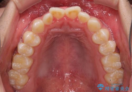 口元の突出感を改善 受け口傾向の咬み合わせの抜歯矯正の治療前