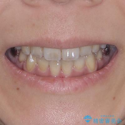 デコボコと口元の突出感　ハーフリンガルでの抜歯矯正の治療後（顔貌）