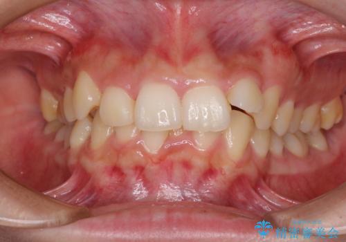 下顎前歯が隠れて突出した口元　ワイヤー装置での抜歯矯正の治療前