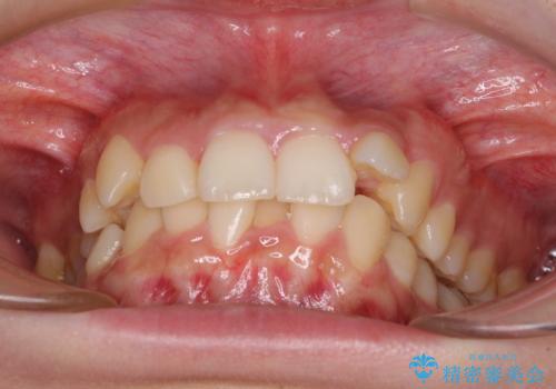 下顎前歯が隠れて突出した口元 ワイヤー装置での抜歯矯正の治療前