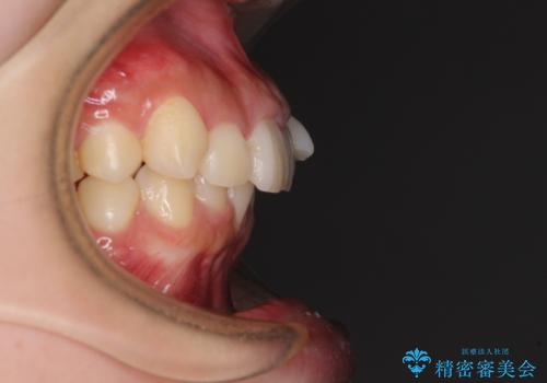 下顎前歯が隠れて突出した口元 ワイヤー装置での抜歯矯正の治療前