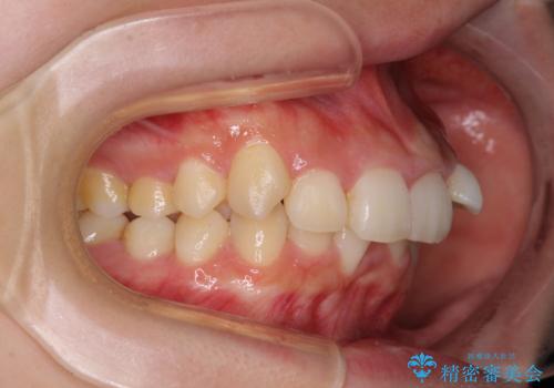 下顎前歯が隠れて突出した口元 ワイヤー装置での抜歯矯正の治療前