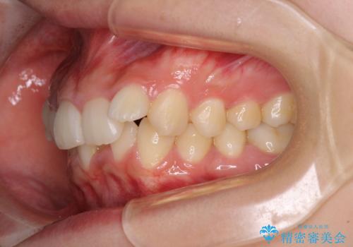 下顎前歯が隠れて突出した口元　ワイヤー装置での抜歯矯正の治療前
