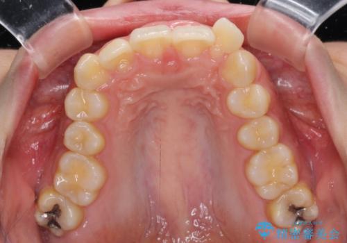 下顎前歯が隠れて突出した口元 ワイヤー装置での抜歯矯正の治療前