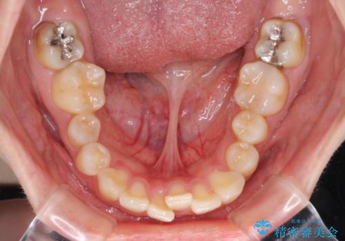 下顎前歯が隠れて突出した口元 ワイヤー装置での抜歯矯正の治療前