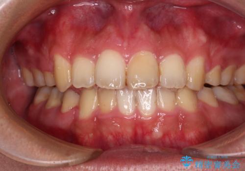 後戻りでデコボコの前歯 インビザライン矯正治療の治療中