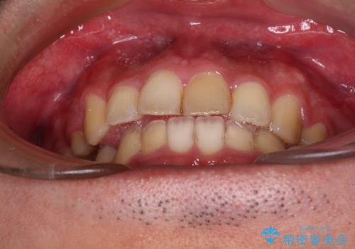 後戻りでデコボコの前歯 インビザライン矯正治療の治療中