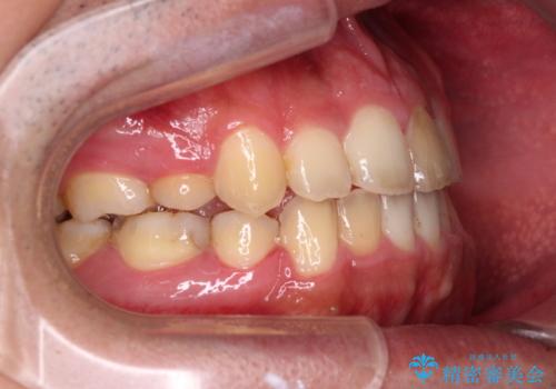 後戻りでデコボコの前歯 インビザライン矯正治療の治療中