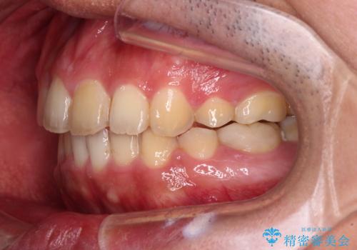 後戻りでデコボコの前歯 インビザライン矯正治療の治療中