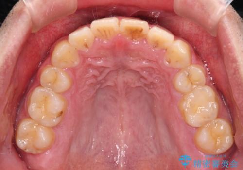 後戻りでデコボコの前歯 インビザライン矯正治療の治療中