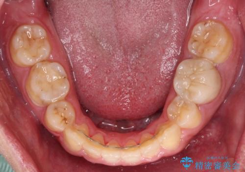 後戻りでデコボコの前歯 インビザライン矯正治療の治療中