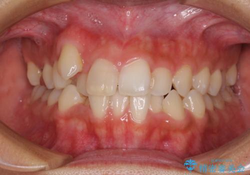 気になる八重歯 目立ちにくいハーフリンガルでの抜歯矯正の症例 治療前