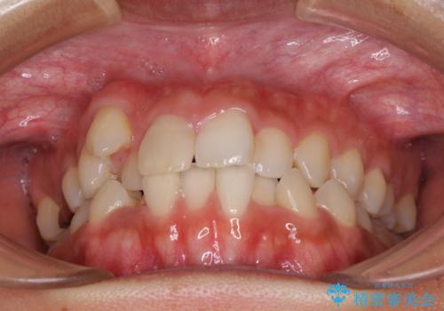 気になる八重歯 目立ちにくいハーフリンガルでの抜歯矯正の治療前