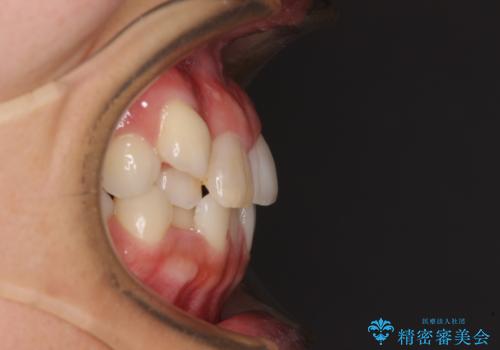気になる八重歯 目立ちにくいハーフリンガルでの抜歯矯正の治療前