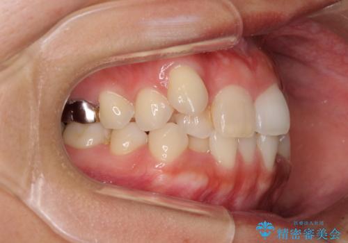 気になる八重歯 目立ちにくいハーフリンガルでの抜歯矯正の治療前