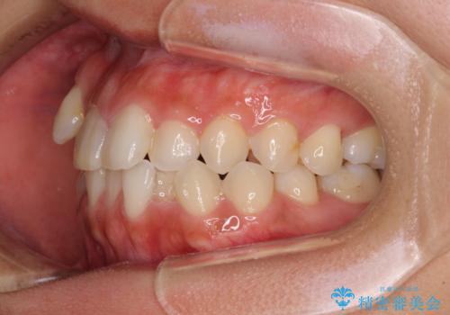 気になる八重歯 目立ちにくいハーフリンガルでの抜歯矯正の治療前