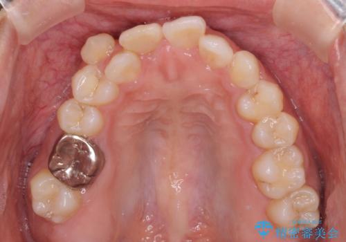 気になる八重歯 目立ちにくいハーフリンガルでの抜歯矯正の治療前