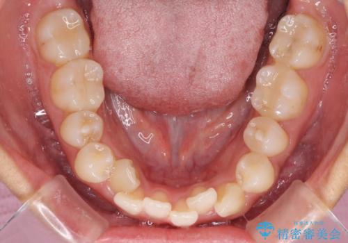 気になる八重歯 目立ちにくいハーフリンガルでの抜歯矯正の治療前